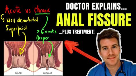 fist in anus|How Anal Fissure Is Treated .